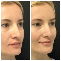 Medical & Acne Treatment Facial image 4
