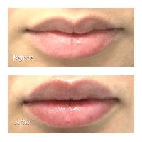 Best Lip Filler & Injections image 8