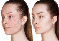 Whiteheads & Blackheads Removal image 13