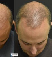 Concord Hair Restoration image 5