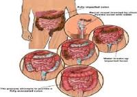 Colonic Irrigation Hydrotherapy NJ image 2