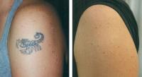 Reversible Ink Tattoo Removal image 4