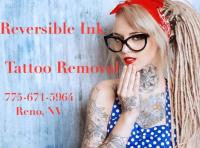 Reversible Ink Tattoo Removal image 6
