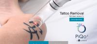 Rethink Laser Tattoo Removal image 5