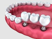 Edgewater Dental - Family Dentist Nampa image 14