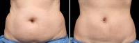 Dr. CoolSculpting San Diego image 3