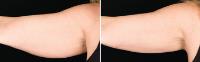 Dr. CoolSculpting San Diego image 4