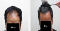 AZ Hair Restoration image 2