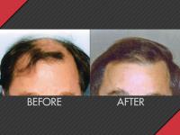 MAXIM Hair Restoration image 2