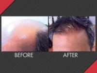 MAXIM Hair Restoration image 3