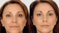 Double Chin Removal image 2