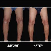 Spider Vein Treatment Paramus image 1