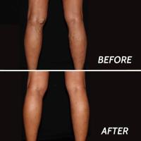 Spider Vein Treatment Paramus image 3