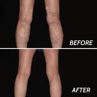 Spider Vein Treatment Paramus image 4