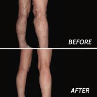 Spider Vein Treatment Paramus image 5