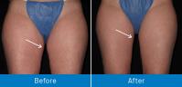 Spider Vein Treatment Paramus image 7