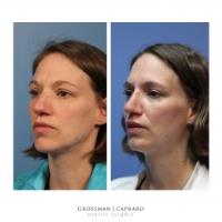 Grossman Capraro Plastic Surgery image 4