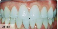 Implant Dentist Bucks County image 5