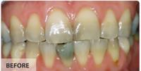 Implant Dentist Bucks County image 6