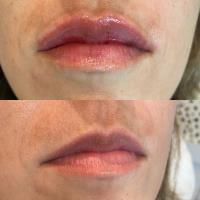 At Your Leisure Aesthetics: Botox and Lip filler image 16