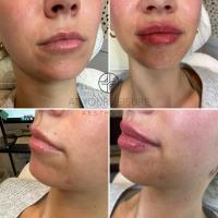 At Your Leisure Aesthetics: Botox and Lip filler image 17