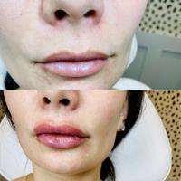 At Your Leisure Aesthetics: Botox and Lip filler image 18