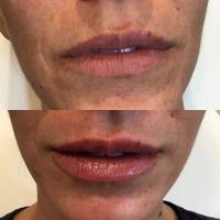 At Your Leisure Aesthetics: Botox and Lip filler image 10