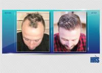 HRS Hair Restoration Specialists image 3