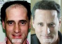 HRS Hair Restoration Specialists image 5