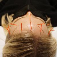 Seyhart Acupuncture image 3