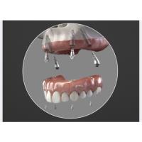 All-On-4 Dental Implants image 2