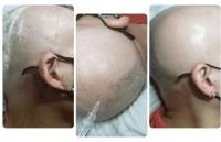Electrolysis 100% Permanent Hair Removal image 2