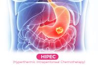 HIPEC Treatment in India image 1