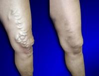 USA Vein Clinics image 2