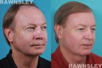 Rawnsley Hair Restoration image 2