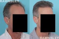 Rawnsley Hair Restoration image 4