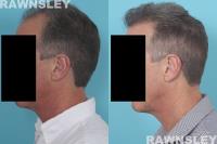 Rawnsley Hair Restoration image 3