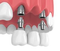 Tooth Extraction in Forest Hills NY image 4