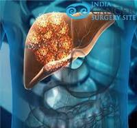 Best Price for Liver Cancer Treatment India image 1