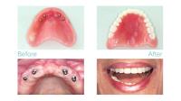 Dental implants periodontist image 3