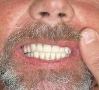 Tampa Dental Implants image 4