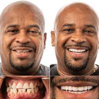 JAX Dental Implants & Dentures image 3