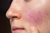 Soothing Your Skin: Rosacea Treatment Explained image 1