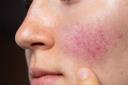 Soothing Your Skin: Rosacea Treatment Explained logo