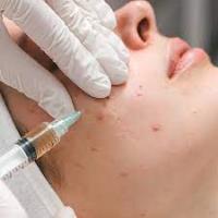 Acne Scar Treatment In Dubai image 1