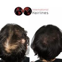 International Hairlines image 1