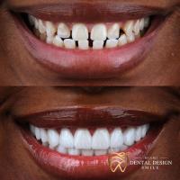 Dental Design Smile Miami image 8