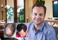 Bosley - Hair Restoration & Transplant image 4