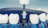 Alvarez Family Dentistry image 8