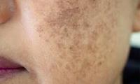 Microneedling: The Key To Smooth And Radiant Skin image 1